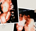 Unggah Foto USG untuk Mensyukuri Kehamilan