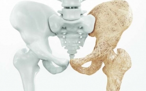Osteoporosis Bagi Lansia