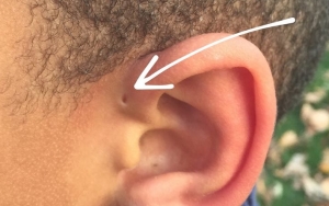 4. Lubang Kecil Tambahan di Telinga