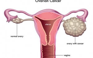 Bawang Merah untuk Mengatasi Kanker Ovarium