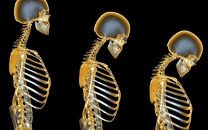 Susu Mencegah Osteoporosis pada Wanita