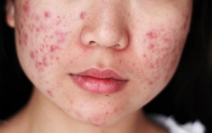 Kulit Sensitif Ditandai dengan Mudah Berjerawat