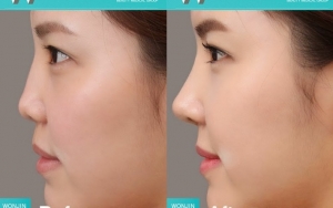 Operasi Pada Area Hidung untuk Membuat Wajah Lebih Simetris
