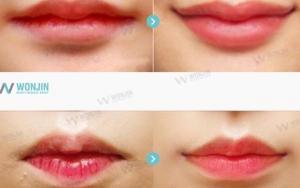Operasi untuk Membuat Garis Bibir