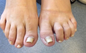 Onychomadesis (Kuku Jari Kaki Tumbuh Abnormal)