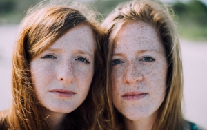 Munculnya Freckles Dipicu Karena Faktor Genetik