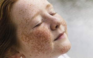 Freckles Mejadi Pengukur Sensitifitas Kulit Terhadap Matahari