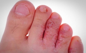Kulit Kering Bersisik Karena Penyakit Dermatitis 