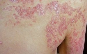 Penyakit Psoriasis Sebabkan Kulit Kering Bersisik