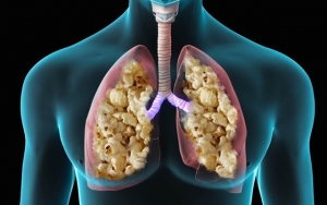Vape Menyebabkan Penyakit Bronchiolitis Obliterans atau Paru-Paru Popcorn