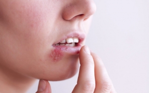 Meningkatkan Resiko Herpes