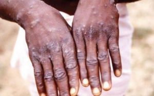 Cacar Monyet Muncul di Singapura, Kemenkes Pastikan Virus Monkeypox Tak Sampai ke Indonesia