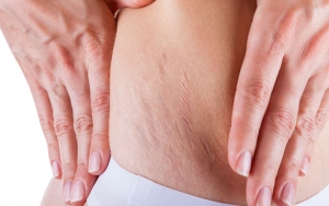 Cewek Wajib Tahu 8 Penyebab Munculnya Stretch Mark di Bokong yang Sulit Diatasi