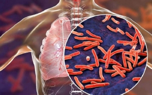 TBC Atau Tuberculosis Juga Bisa disebabkan seringnya terpapar angin malam