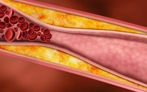 Bengkuang Mampu Menurunkan Kadar Kolesterol Darah
