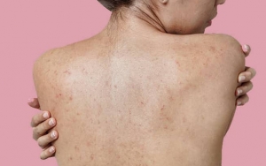 Body Lotion Dapat Mencegah Masalah Kulit Terutama Jerawat