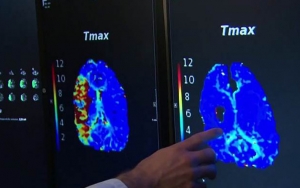 Yang Terparah, Membunyikan Tulang Dapat Menimbulkan Stroke