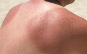 Ingat Untuk Jangan Pernah Menggaruk Luka Sunburn