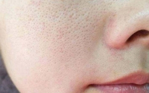 Masker Putih Telur Bisa Mengecilkan Pori-Pori, Coba Sekarang!