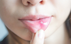 Mengunyah Dengan Cepat Bisa Melukai Bibir Dan Menimbulkan Sariawan