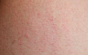 Jika Makin Gatal, Kalian Ptut Curigai Dermatitis Atopik (Eksim)