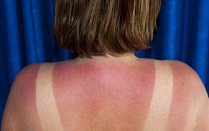 Ringankan Kulit yang Terbakar atau Sunburn dengan Menggunakan Air Mawar