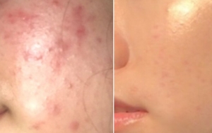 Sebal dengan Kemunculan Jerawat di Wajah? Atasi Saja dengan Menggunakan Masker Beras