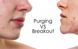 Sering Dianggap Sama, Berikut Caranya Membedakan Purging Dan Breakout