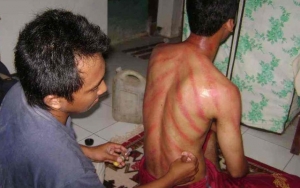 Kerokan Aman Dilakukan Selama Tidak Berlebihan