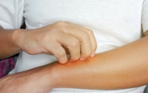 Meminum Antibiotik Tanpa Arahan Dokter Juga Bisa Picu Alergi
