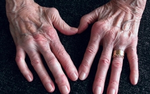 Rheumatoid Arthritis Atau Yang Sering Disebut Rematik Juga Salah Satu Penyakit Autoimun
