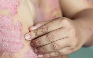 Psoriasis, Penyakit Autoimun Yang Menyerang Kulit Kalian