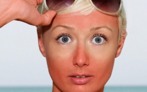 Mengatasi Sunburn