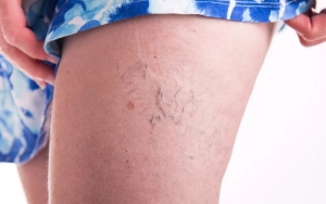 Menimbulkan Spider Veins