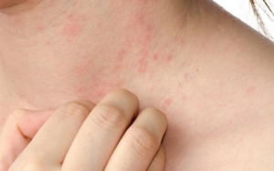 Memicu Alergi dan Iritasi