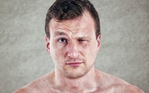 Mengakibatkan Sindrom Bell's Palsy
