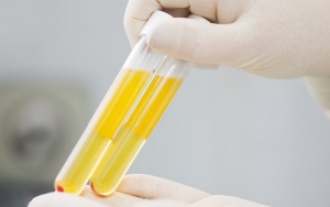 Tak Sembarangan, Ini Kriteria Khusus Pasien Sembuh COVID-19 yang Bisa Donor Plasma Darah