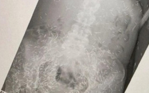 Heboh Penampakan 'Benda Gaib' Susuk Terekam X-Ray, Begini Penjelasan Pakar Radiologi