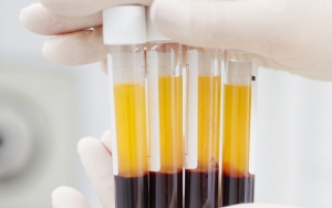 Jadi Terapi Mujarab Pasien, Penyintas COVID-19 Bisa Donor Plasma Darah 2 Pekan Sekali