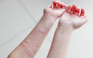 Sering Muncul Tiba-tiba, 8 Tips Ini Bisa Kalian Coba Untuk Redakan Gatal Saat Biduran