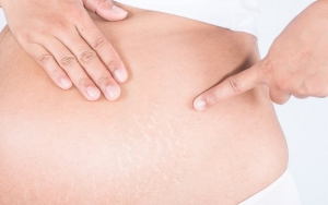 Cermat Saat Memilih Produk yang Mencegah Stretch Mark