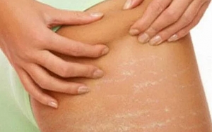 Bikin Tak Percaya Diri, Ini 7 Cara Ampuh Hilangkan Stretch Mark Putih di Tubuh