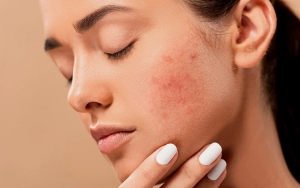 Bersifat Anti-Inflamasi untuk Jerawat