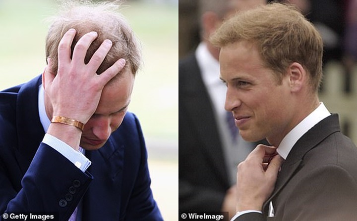 Aktor Ini Sebut Kepala Botak Pangeran William Membuatnya Trauma