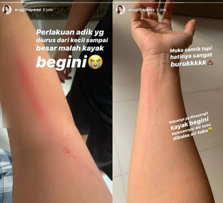 Anggi Dicakar Della Perez?