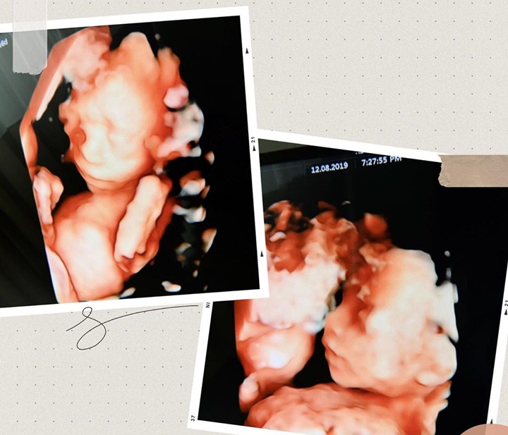 Unggah Foto USG untuk Mensyukuri Kehamilan