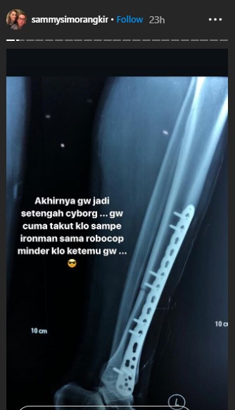 Begini Kondisi Terkini Sammy Simorangkir Pasca Operasi Karena Alami Kecelakaan Motor