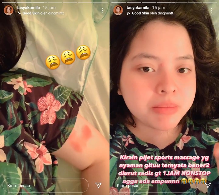 Tasya Kamila Posting Foto Lengan Lebam-lebam Jadi Sorotan, Ada Apa?