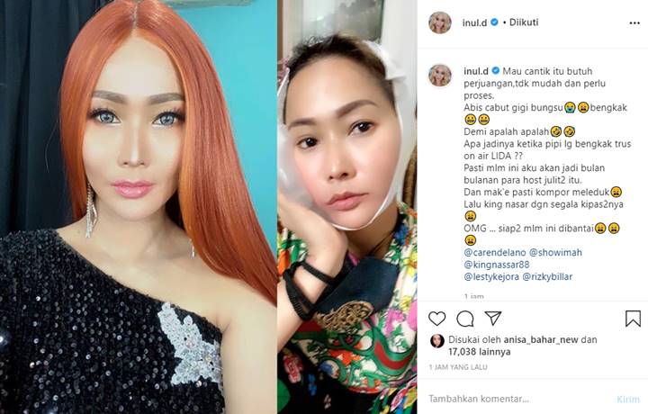 Inul Daratista Tunjukkan Wajah Bengkak Setelah Cabut Gigi: Siap-siap Dibully