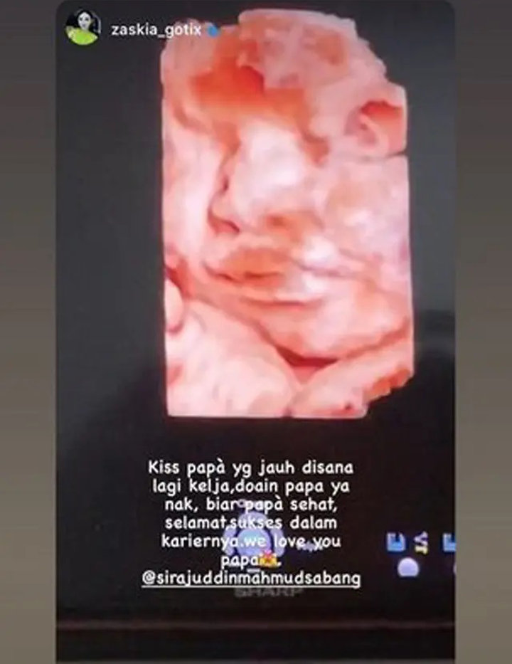 Zaskia Gotik Pamer Foto USG Calon Bayi, Penampakan Hidung Janin Jadi Sorotan